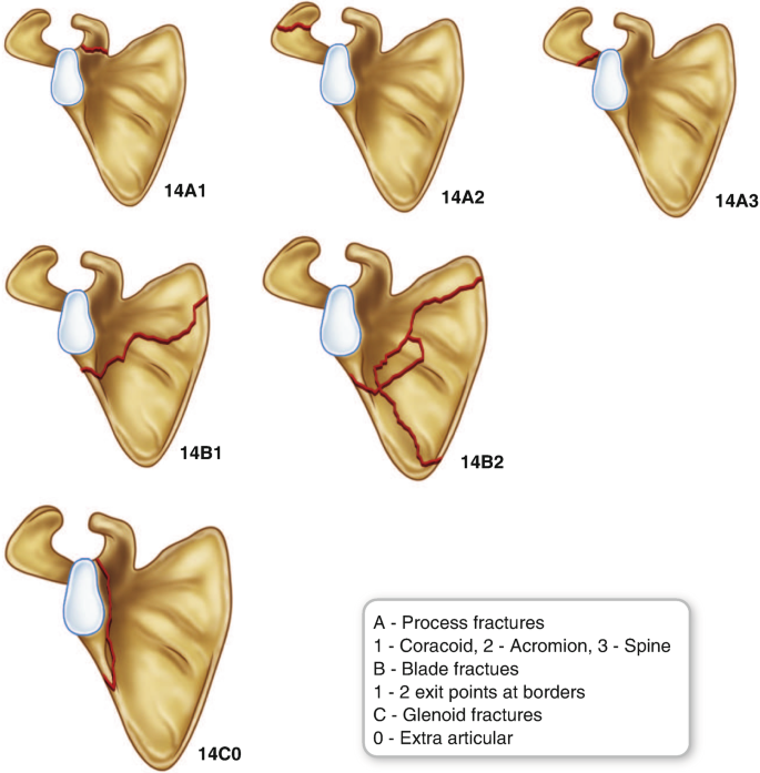 Classification Systems for Scapular Fractures How Useful Are They