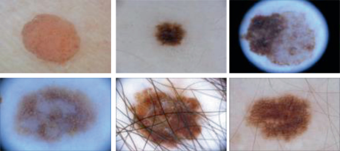 Multiscale Feature Fusion Using Hybrid Loss for Skin Lesion ...