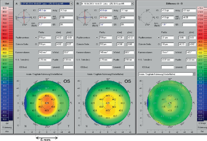 Hyperpic Hyperopic Correction by SMILE | Springer Nature Link