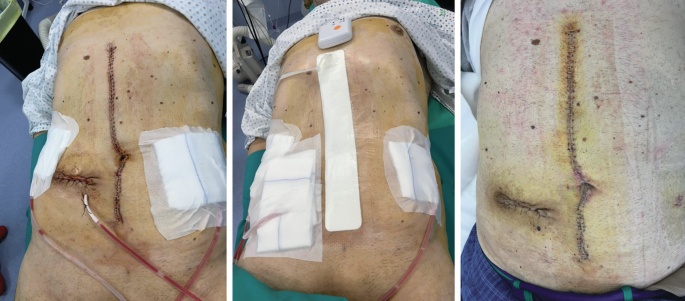 Surgical Wounds: Principles of Postoperative Care | Springer Nature Link
