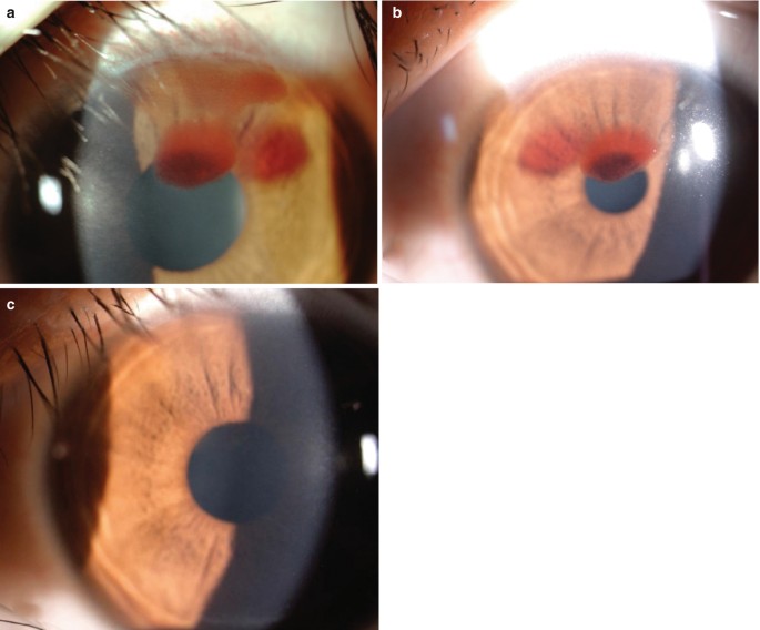 Miscellaneous Refractive Surgery Complications SpringerLink