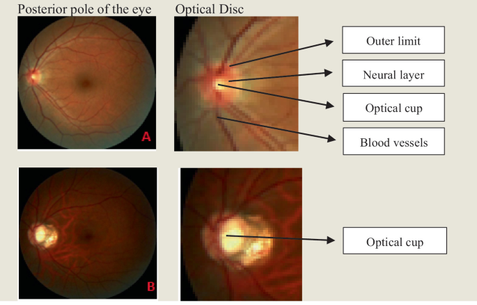 A Vision Transformer Approach to Fundus Image Classification | Springer ...