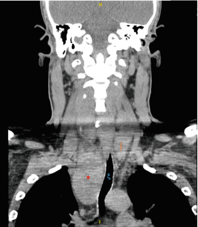 Goiter and Benign Thyroid Nodules | Springer Nature Link