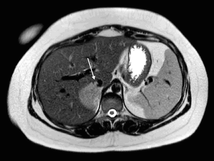 An M R I scan reveals a tumor on the right adrenal gland. The tumor has spread, forming a clot containing cancer cells in the inferior vena cava, indicated by an arrow.
