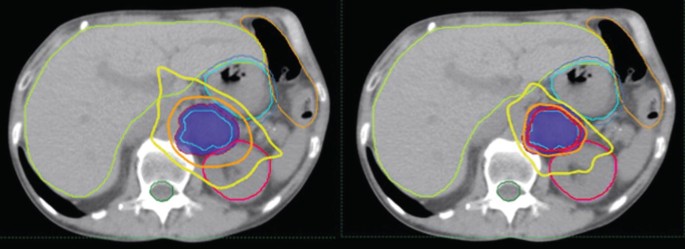 Two C T scans depict a 3-dimensional view of the adrenal cortex, highlighting the outer region of adrenal gland cancer and the tumor's spread to adjacent tissues surrounding the adrenal cortex.