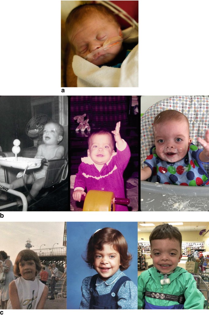 Low Set Features Noonan Syndrome | SpringerLink