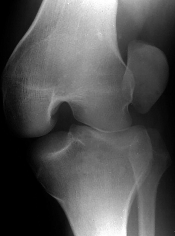 Traumatic Dislocation of the Patella SpringerLink