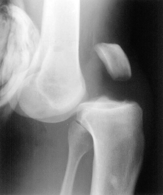 Knee Dislocations SpringerLink