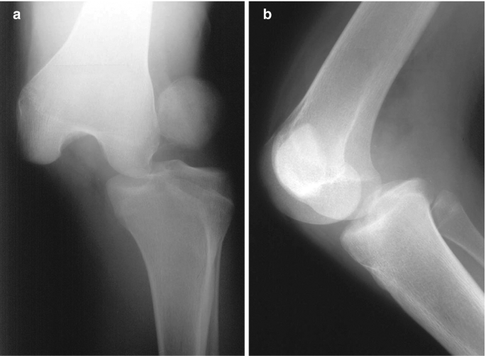 Knee Dislocations SpringerLink