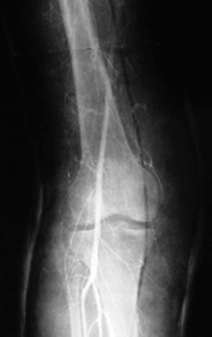 Knee Dislocations SpringerLink