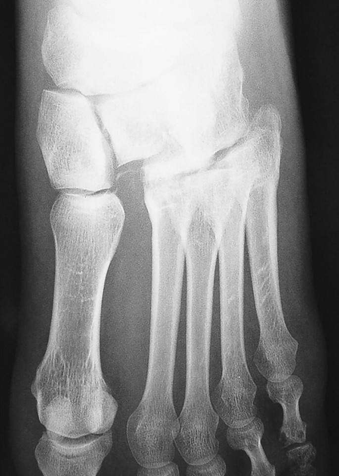 Foot and Ankle Dislocations SpringerLink