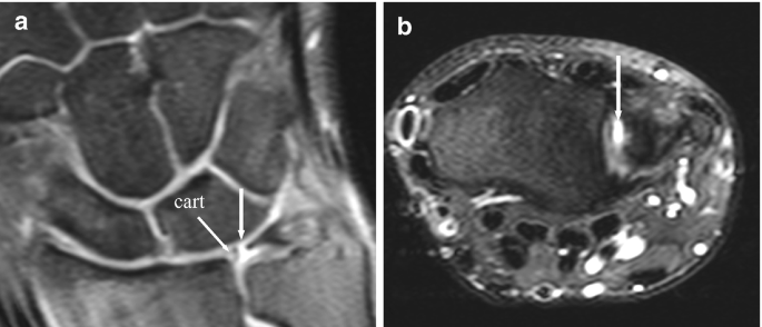 Two scans reveal a tear in the central portion of the T F C C. There is a central perforation of the T F C C without displacement.