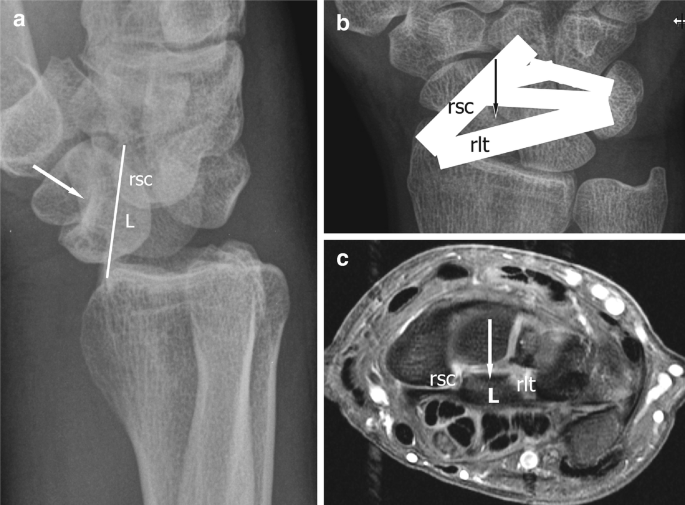 Three scans. A carpal bone in the wrist is dislocated with an abnormal space between the palmar r s c and r l t ligament.