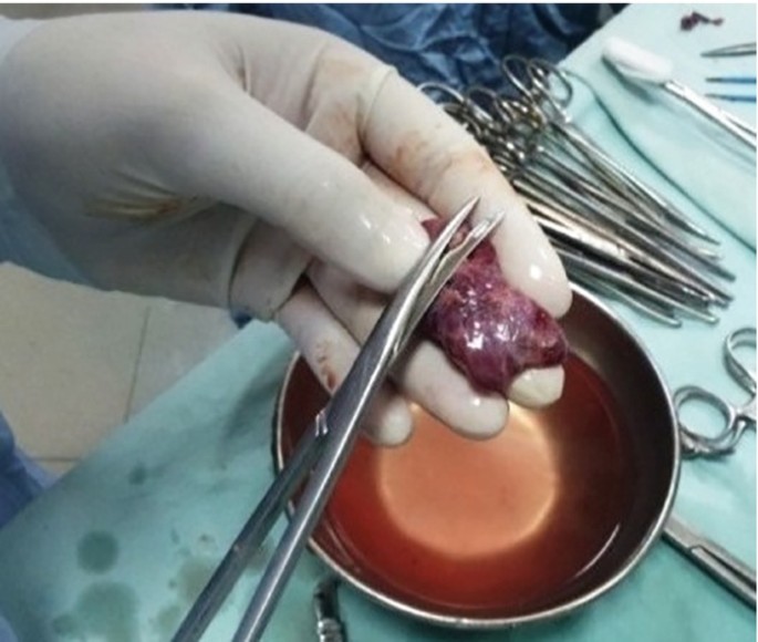 Thyroid and Parathyroid Transplantation | SpringerLink