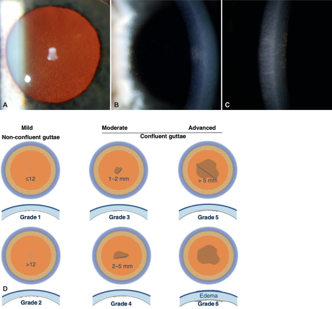 Fuchs Endothelial Corneal Dystrophy FECD | Springer Nature Link ...