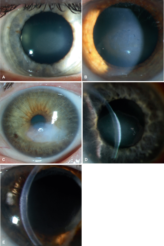 Fuchs Endothelial Corneal Dystrophy FECD | Springer Nature Link ...