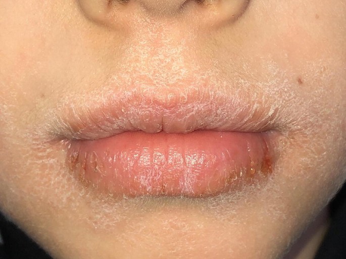 Lip Crust Disorders/Diseases of the Lips, Tongue, and Oral Mucosa | SpringerLink