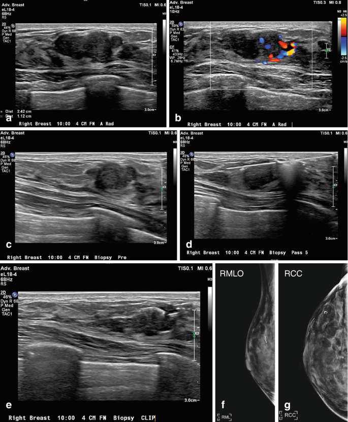 Image-Guided Breast Interventions | Springer Nature Link