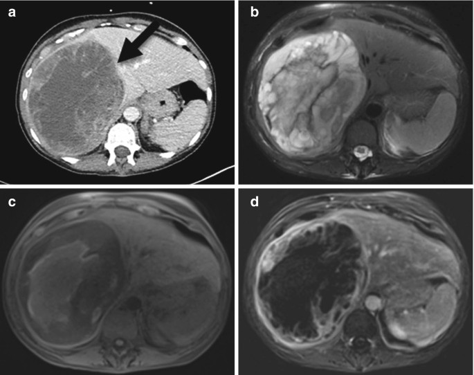 Complex Cystic Liver Lesion SpringerLink