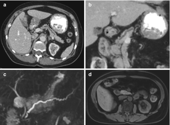 Ductal Dilatation without Perceptible Mass SpringerLink