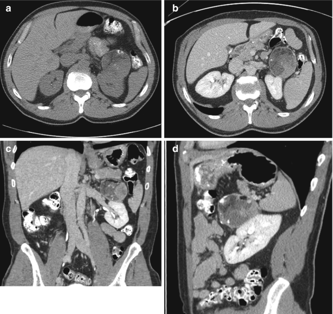 Retroperitoneal Lesion Containing Macroscopic Fat and Calcification