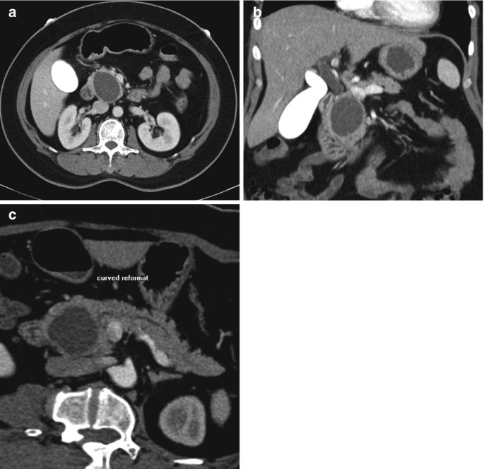 Serous Oligocystic Adenoma Pancreas SpringerLink