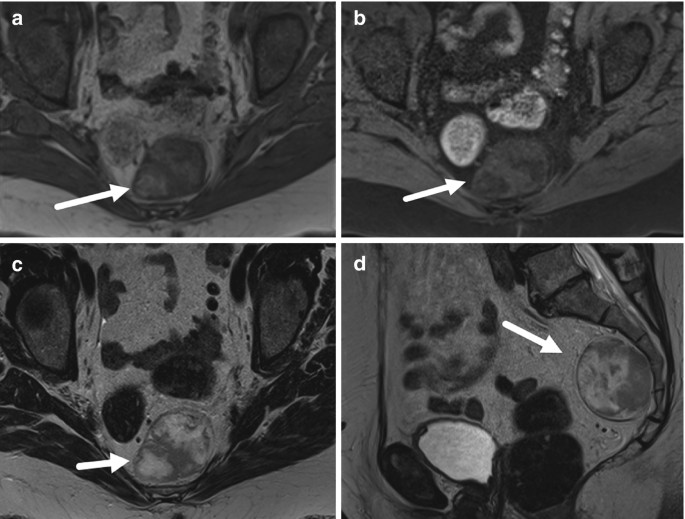 Presacral Angiomyolipoma SpringerLink