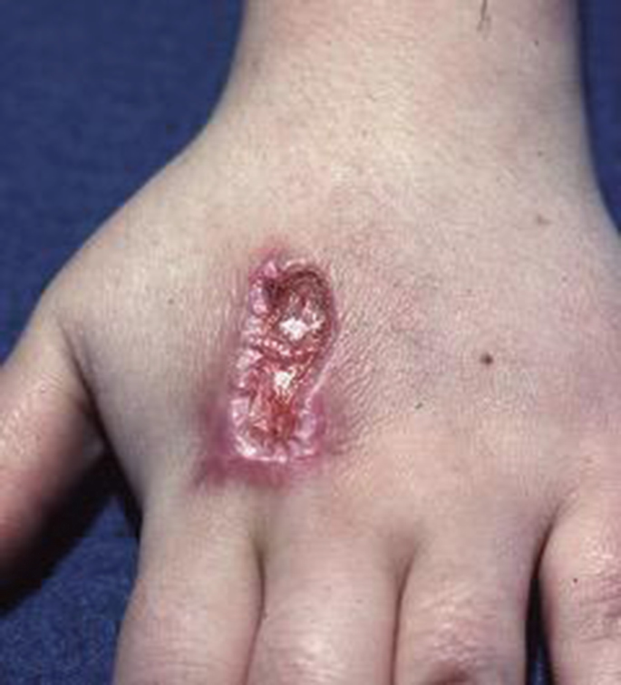 cigarette burn on hand Self-Inflicted Skin Disorders: Diagnosis and Management