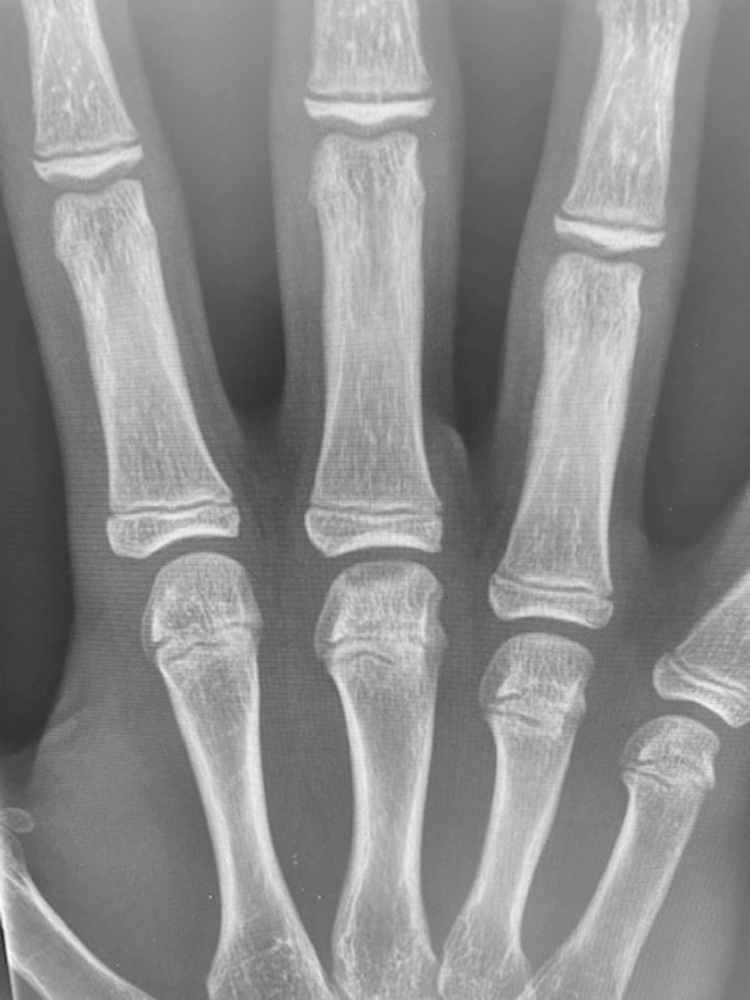 Physeal Stress Injuries of the Hand/Fingers | SpringerLink
