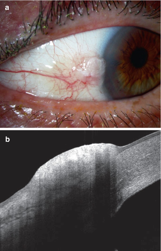 Conjunctival Tumors: Examination Techniques | Springer Nature Link