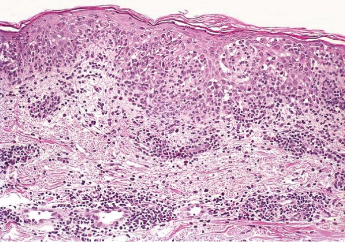 Polymorphic Light Disruption Polymorphous Light Eruption Pathology Outlines
