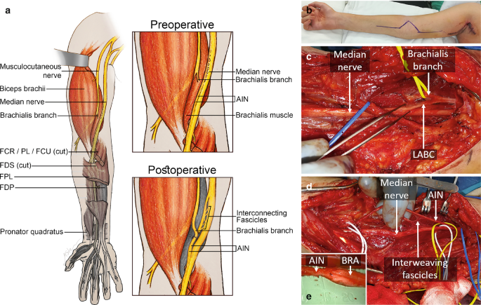 Nerve Transfers for Cervical Spinal Cord Injury | SpringerLink