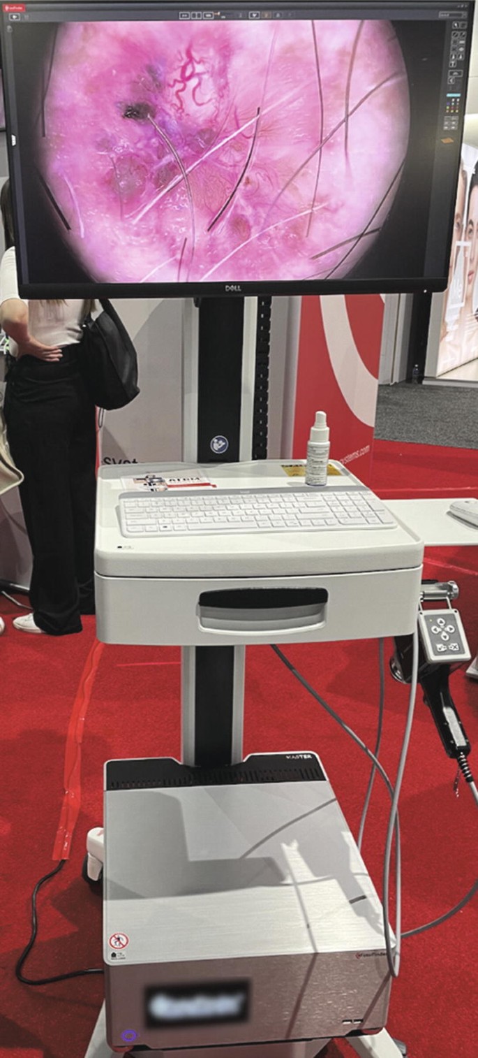 Trichoscopy | SpringerLink
