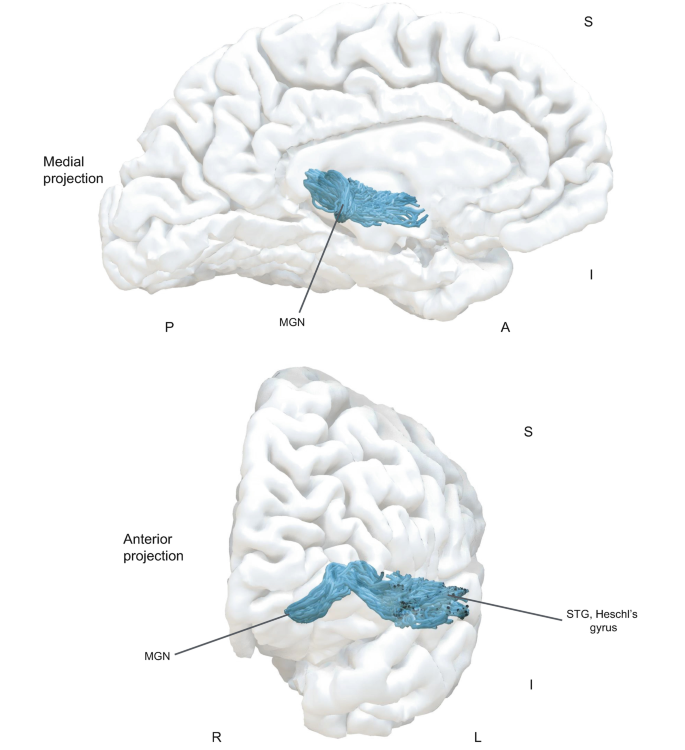 Stg Brain Acoustic Radiation | Springer Nature Link
