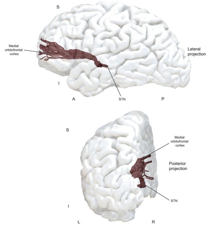 Ventromedial Subthalamic Projections | Springer Nature Link