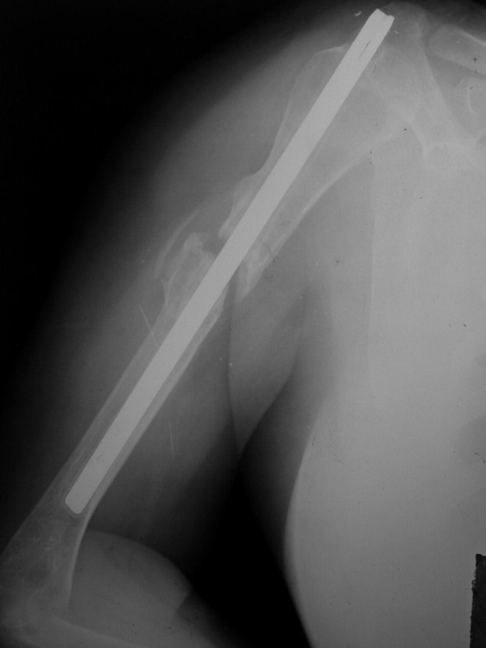 Humerus Nonunion Treated with Fixator Augmented Rod Technique ...