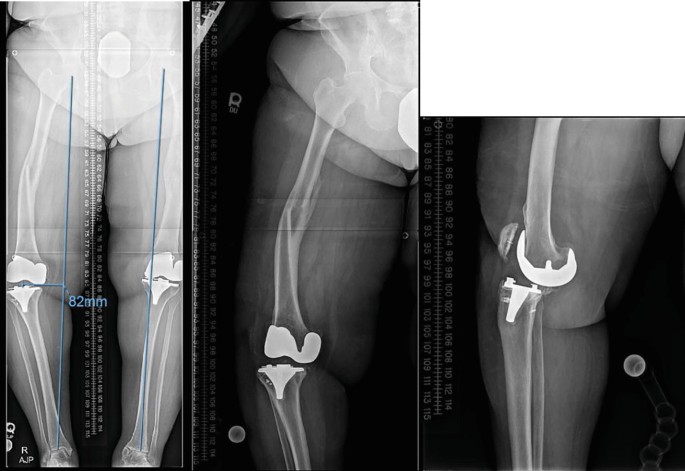 Extra-Articular Deformity Correction for Staged Revision Total Knee ...