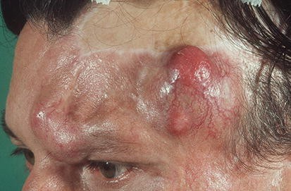 Premalignant and Malignant Tumours | Springer Nature Link