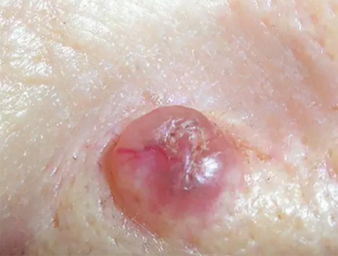non melanotic invasive skin cancer Nonmelanoma Skin Cancer