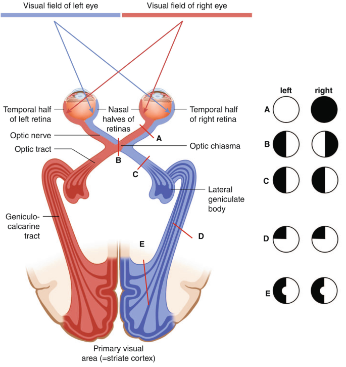 Contraction Visual Field What Is Temporal Visual Field