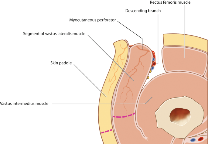 Anterolateral Thigh/Vastus Lateralis Flap | SpringerLink