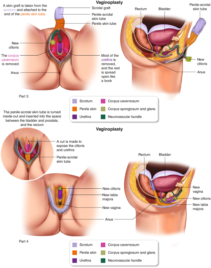 Genital Surgery for Transgender and Gender-Diverse Individuals