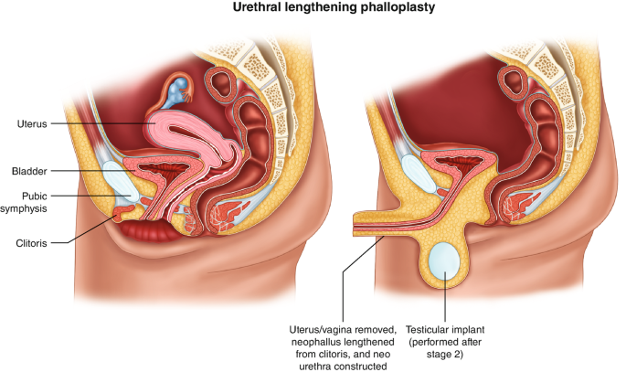 do trans vaginas self lubricate Vaginoplasty and Other Gender-Affirming Genital Surgical Options main image 1