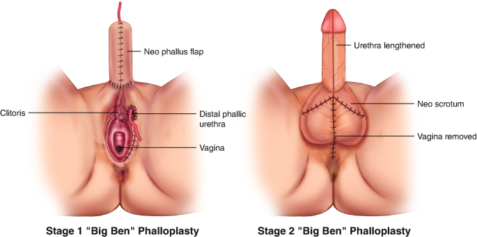 Genital Surgery for Transgender and Gender-Diverse Individuals | Springer Nature Link Genital Surgery for Transgender and Gender-Diverse Individuals | Springer Nature Link