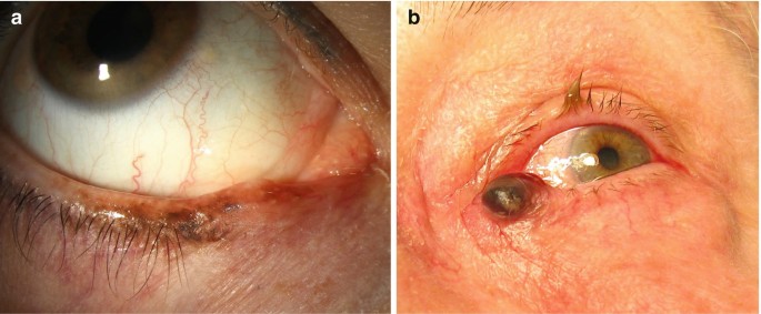 Eyelid Tumors
