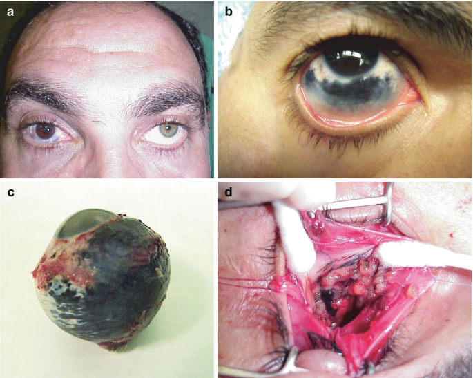 melanotic sarcoma begins with Melanotic neuroectodermal tumor in a newborn main image 1