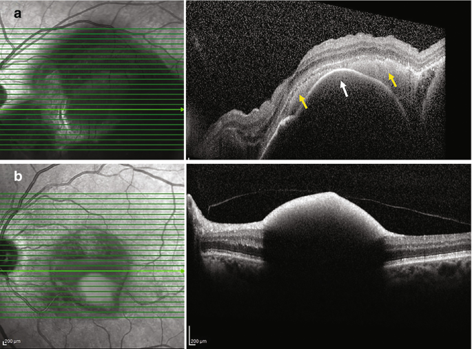 Submacular Hemorrhage | Springer Nature Link