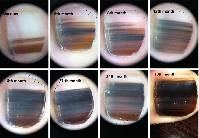 melanotic macule of matrix nail unit and its clinicopathologic spectrum The Art of Nail Findings