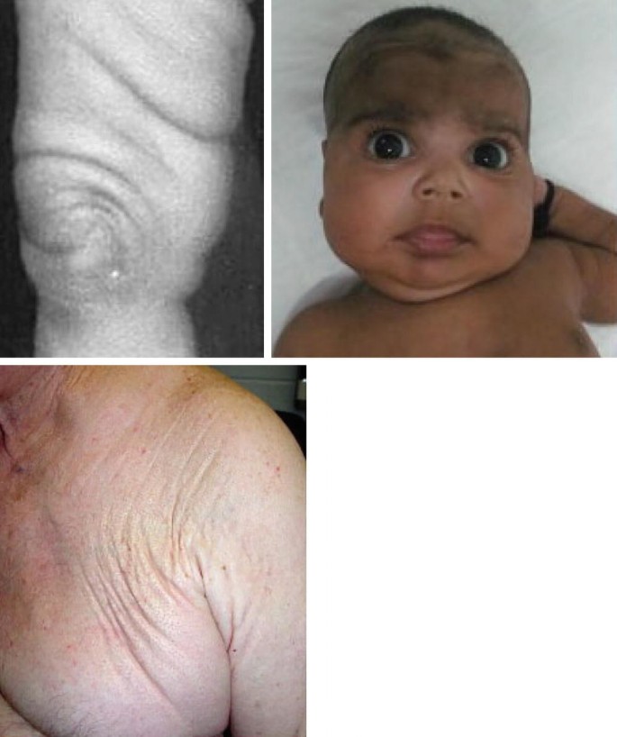 bpc 157 ehlers danlos Peptides like BPC-157 and TB-500 can aid healing, but don’t overlook the  basics for connective tissue repair. Focus on vitamin C (2-10g/day),  protein (1g per pound of body weight), essential amino main image 0