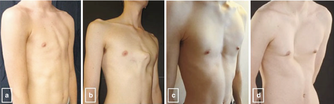bpc 157 ehlers danlos Classifications/Differential Diagonses of Ehlers–Danlos Syndrome Color:Lavender Peptide News: Amazon just Vitamin B12 Deficiency Anaemia
